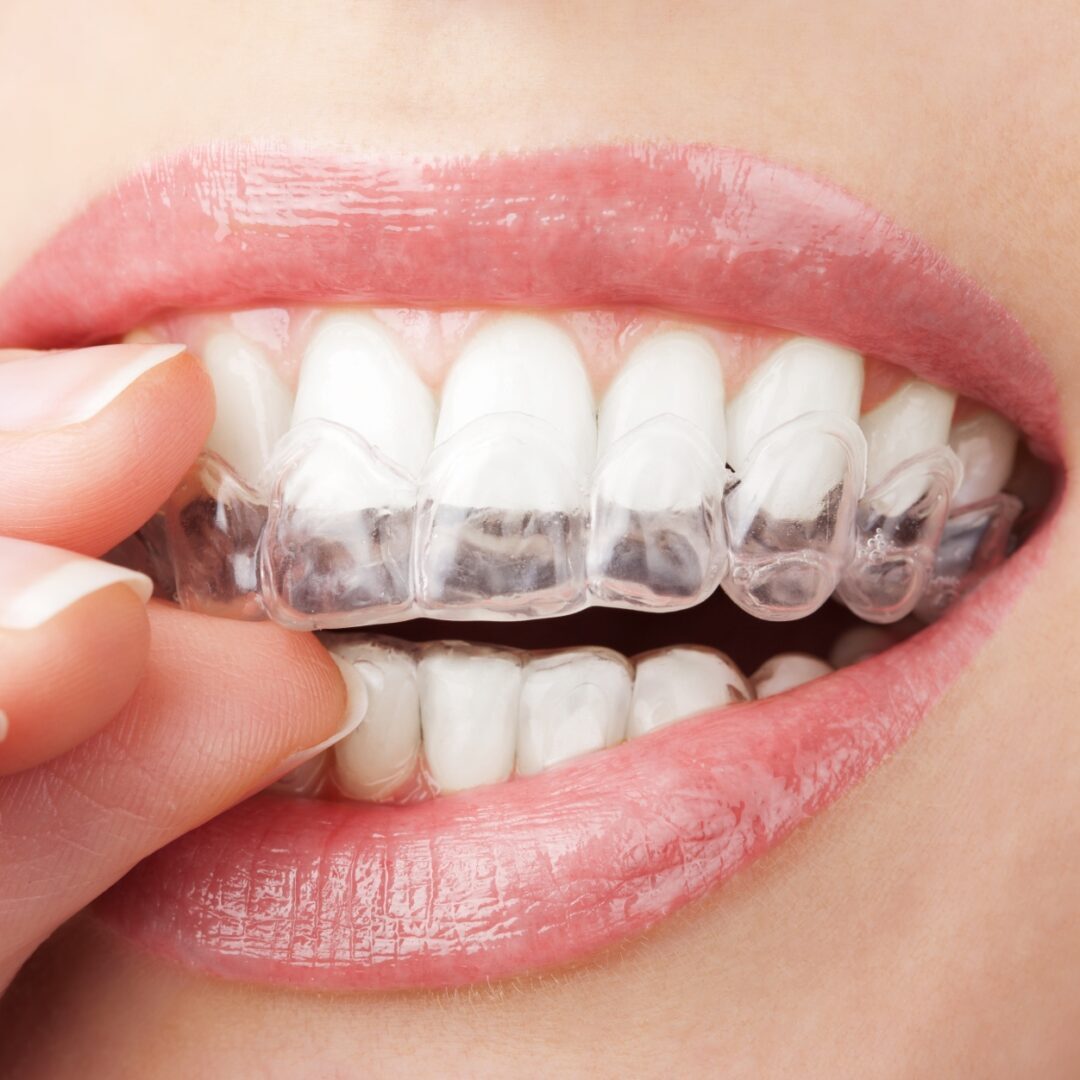 Close-up of a person inserting a clear dental aligner onto their upper teeth.